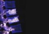 Vertebroplastica percutanea: procedura e indicazioni Vertebroplastica Percutanea