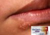 NOVARTIS: ”Vectavir” BATTE L’ HERPES LABIALE SUL TEMPO! Images Public Dps News Herpes250x 618614