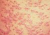 Images Public Dps News Psoriasis 429848