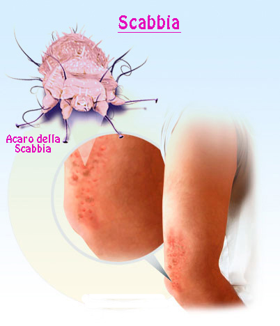 acaro della scabbia
