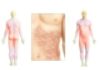 orticaria