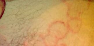 Dermatite Eczema nummulare - l'eczema