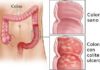 Colite-ulcerosa-
