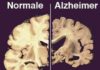 alzheimer-cervello