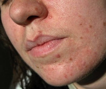 acne1