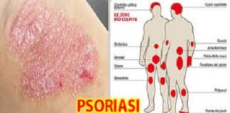 PSORIASI