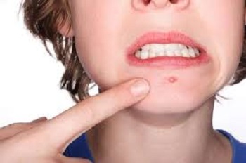 Acne Giovanile acne giovanile