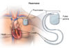 pacemakers