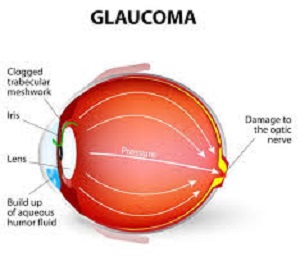Glaucona GLAUCONA