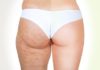 cellulite