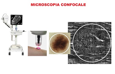 Tumori Della Pelle Microscopia Confocale R Tumori della pelle microscopia confocale r