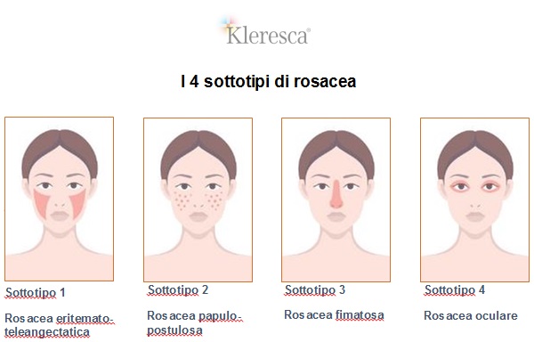 Trattamento Rosacea Kleresca 2