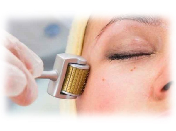 micro needling o