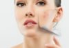 medicina estetica non invasiva per eliminare cicatrici da acne