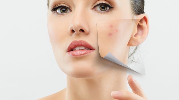 medicina estetica non invasiva per eliminare cicatrici da acne