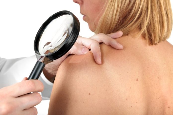 Il Carcinoma A Cellule Di Merkel Il carcinoma a cellule di Merkel