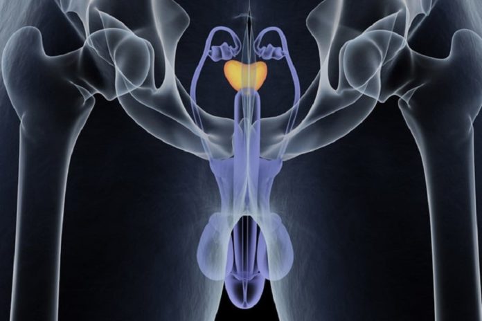 Prostate Urine Risk - nuovo test cancro alla prostata
