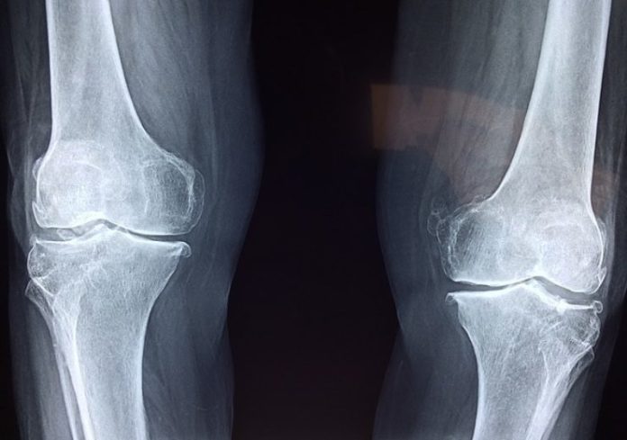 First Human Surgical Procedure With Injectable Ha Based Bone Repair Therapy First Human Surgical Procedure with Injectable HA-Based Bone Repair Therapy