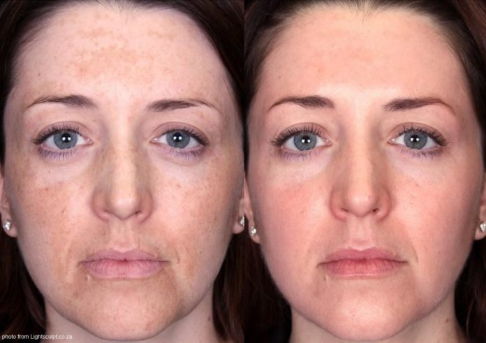 Addio Melasma addio melasma