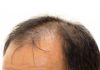 CADUTA DEI CAPELLI alopecia mascile