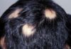 ALOPECIA AREATA RICONOSCIUTA MALATTIA AUTO-IMMUNE r