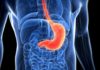 Tumori gastrointestinali apparato gastrointestinale