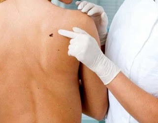 Melanoma Nuova Terapia Mirata Melanoma - Nuova terapia mirata