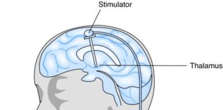 Stimolatore Cervello