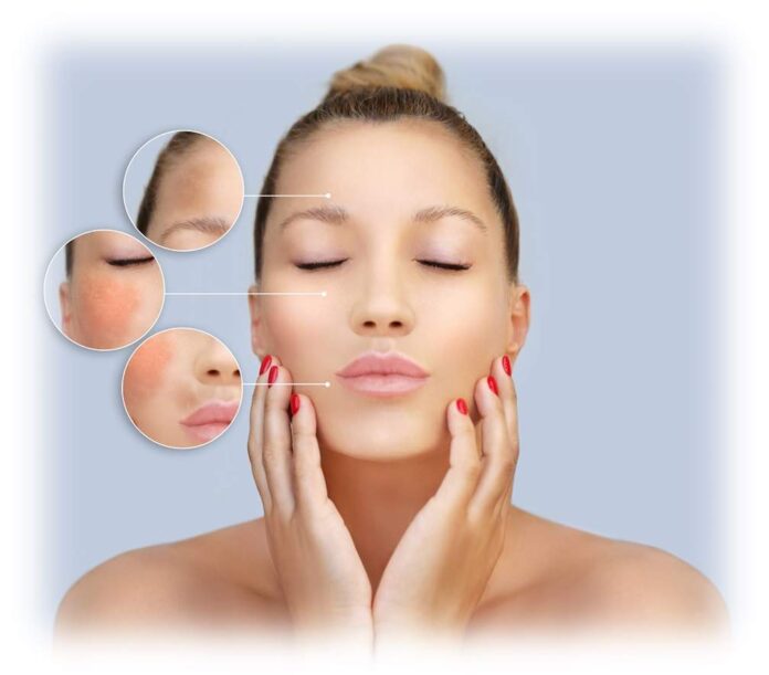 Melasma Melasma - macchie della pelle