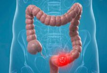 tumore del colon retto
