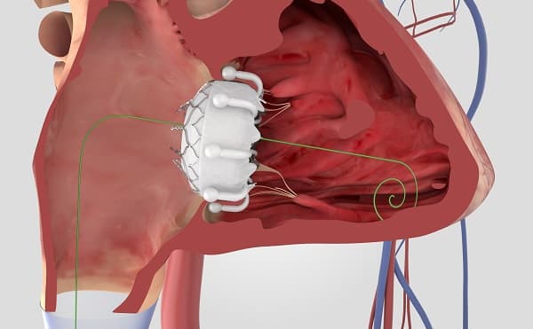 Evoque Tricuspid Procedure Evoque Tricuspid Procedure