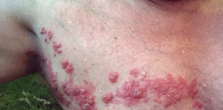 Herpès Herpes Zoster Fuoco di Sant'Antonio