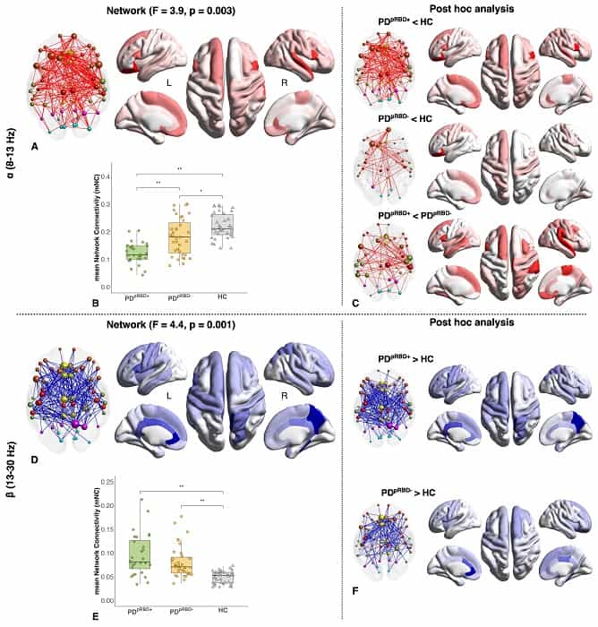 Nuova mappa del cervello Parkinson Nuova mappa del cervello