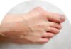 Alluce valgo Allux Valgus or Bunion