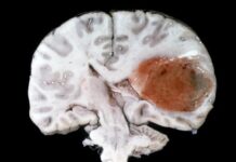 Anticorpo contro il glioblastoma