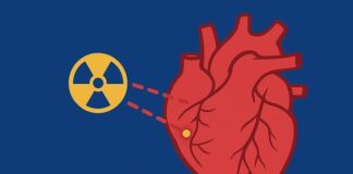 Radioterapia stereotassica nuova cura per aritmie gravi