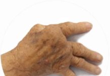 Artrite reumatoide _ Rheumatoid Arthritis - ph James Heilman - wikipedia