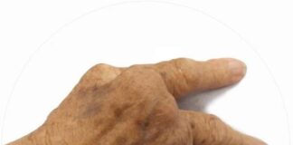 Artrite reumatoide _ Rheumatoid Arthritis - ph James Heilman - wikipedia