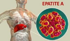 Epatite A