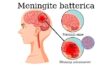 Meningite