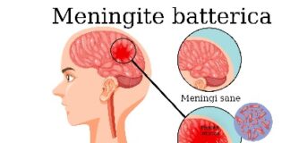 Meningite