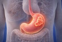 Tumore dello stomaco e farmaci