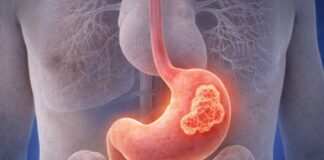 Tumore dello stomaco e farmaci