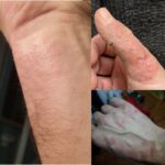 eczema cronico delle mani