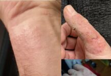 Una svolta terapeutica per l’eczema cronico delle mani eczema cronico delle mani