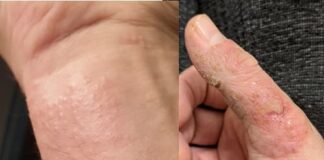 eczema cronico delle mani