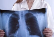 Fibrosi polmonare Campania nuovo modello di cura Fibrosi polmonare Campania