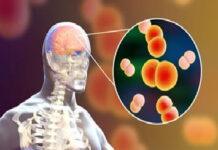 Meningite nel Parmense